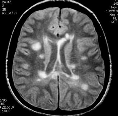 Снимок диагностика рассеянного склероза на МРТ